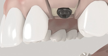 Implantation in 1 Schritt