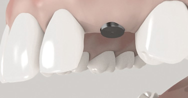 Implantation in 2 Schritten